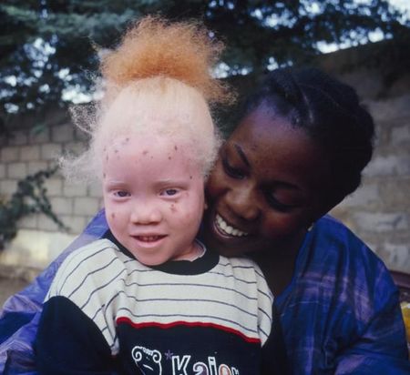Mali : Découverte du corps d’une petite fille albinos victime d’un crime rituel