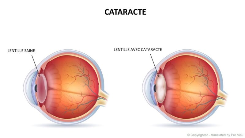 Santé : La 2è édition du projet sino-béninois d’opérations de la cataracte en gestation