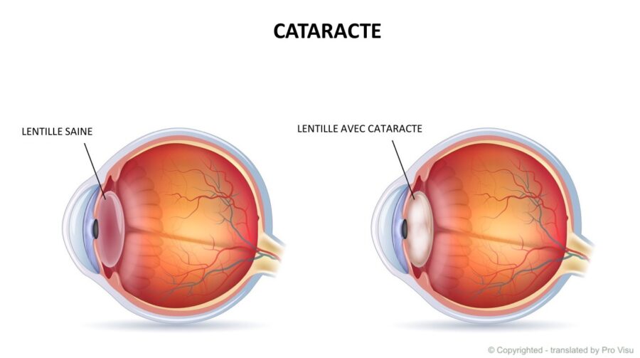 Santé : La 2è édition du projet sino-béninois d’opérations de la cataracte en gestation